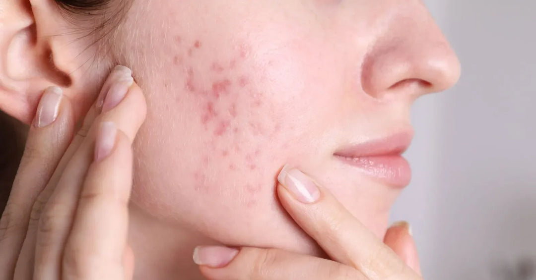 How to Choose the Best Ayurvedic Skincare Brand in India for Sensitive & Acne-Prone Skin